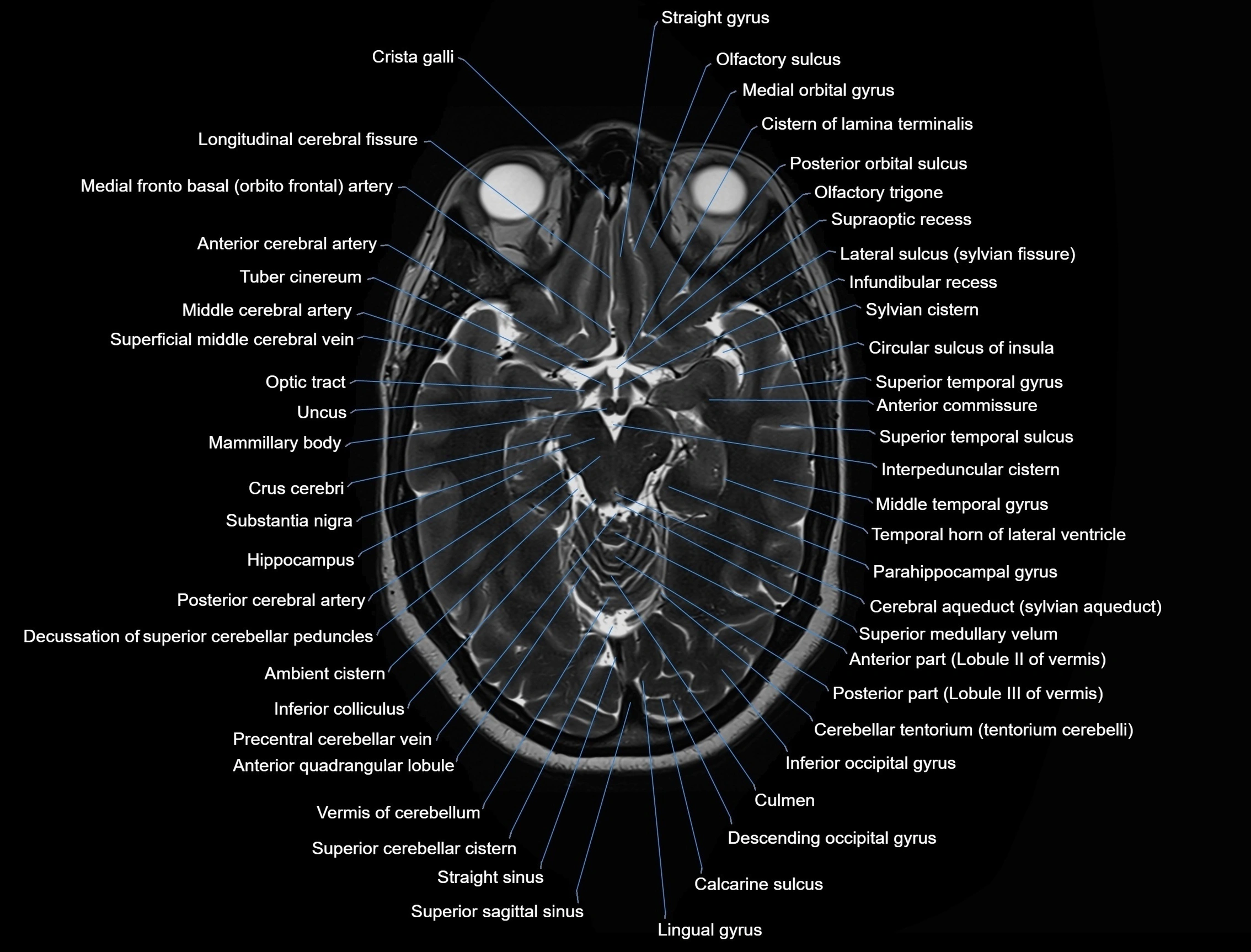 MRI Brain axial cross sectional radiology anatomy 3T image  -img-00001-00023.webp